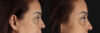 Blepharoplasty case #263975 slider thumbnail