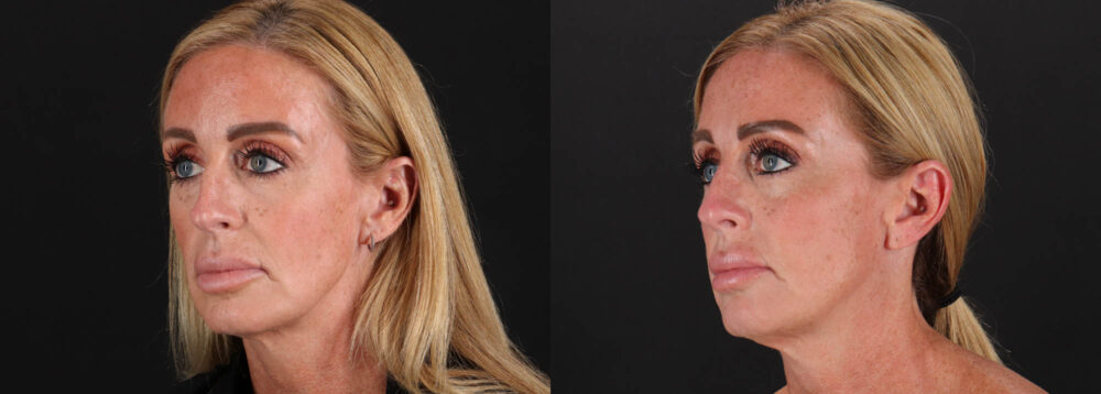 Filler case #263983