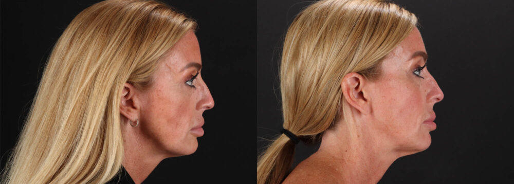 Filler case #263983