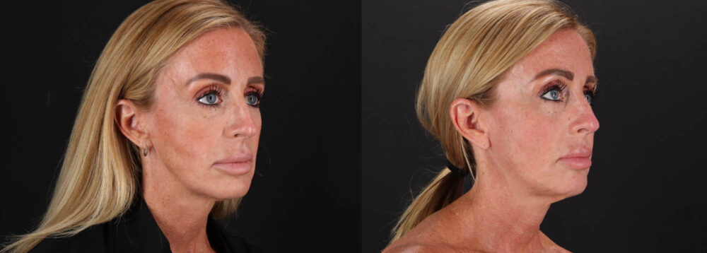 Filler case #263983