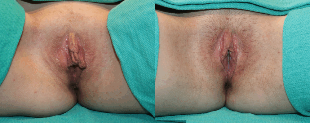 Labiaplasty case #263446