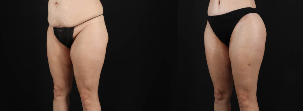 Tummy Tuck case #263466