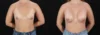 Breast Augmentation case #264418 slider thumbnail