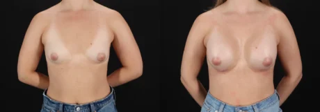 Breast Augmentation case #264418