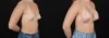 Breast Augmentation case #264418 slider thumbnail