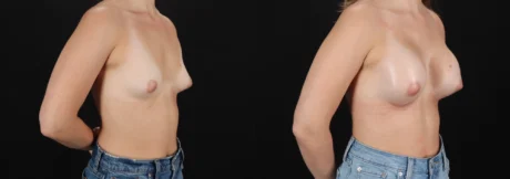 Breast Augmentation case #264418