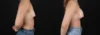 Breast Augmentation case #264418 slider thumbnail