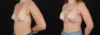 Breast Augmentation case #264418 slider thumbnail